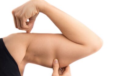 Cryolipolyse des bras : tout savoir