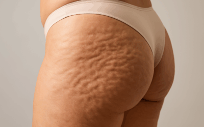 Peau d’orange, bourrelets localisés, perte de fermeté : comment la cryolipolyse peut-elle vraiment aider ?
